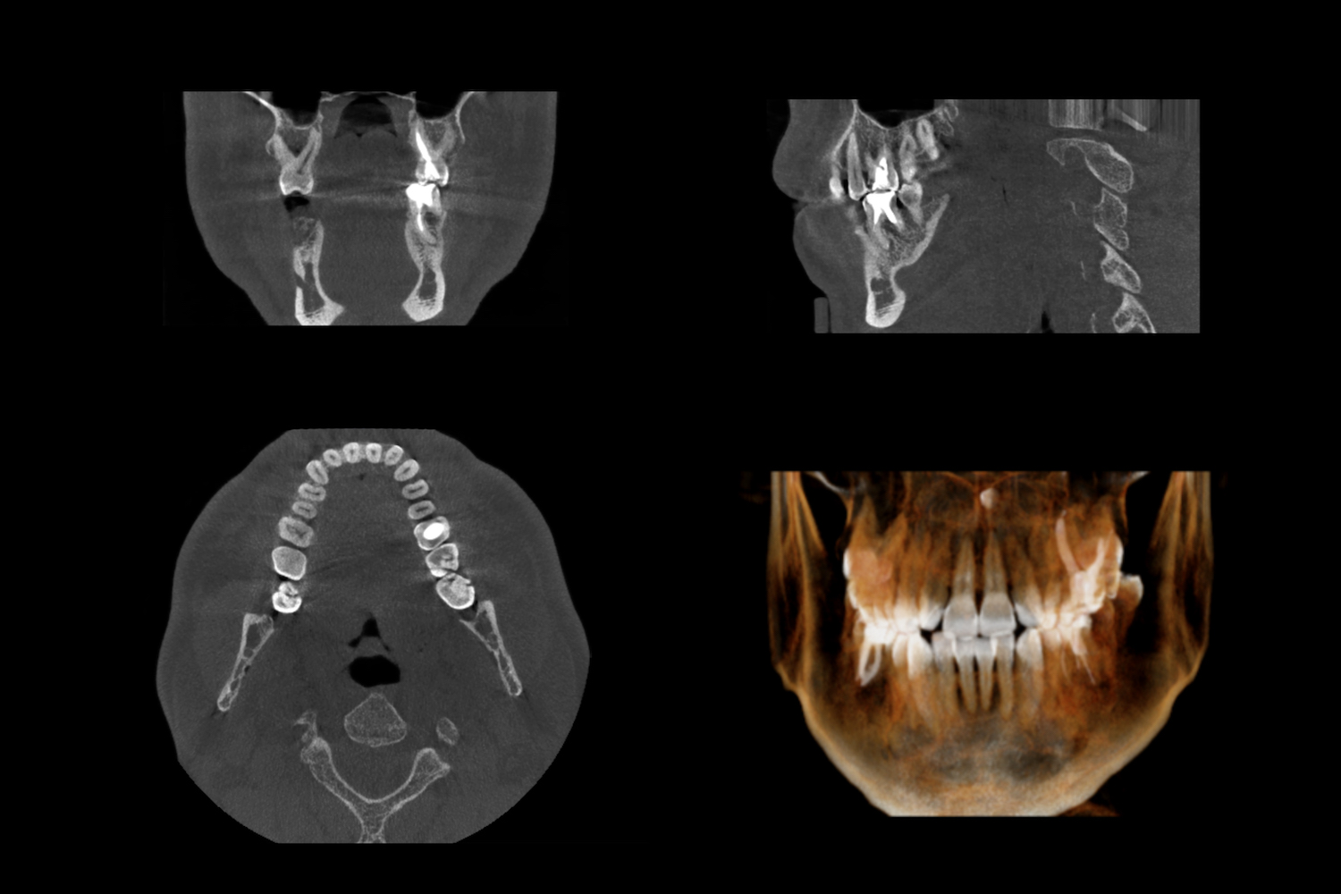 bonegrafting