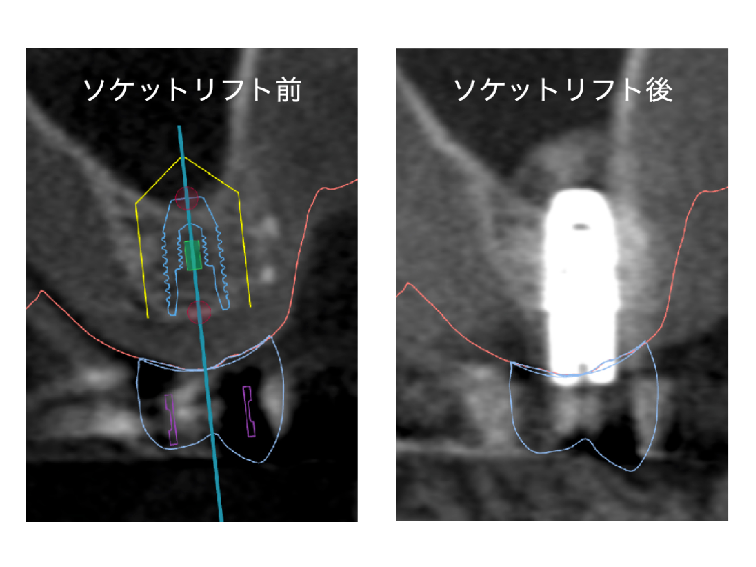 bonegrafting