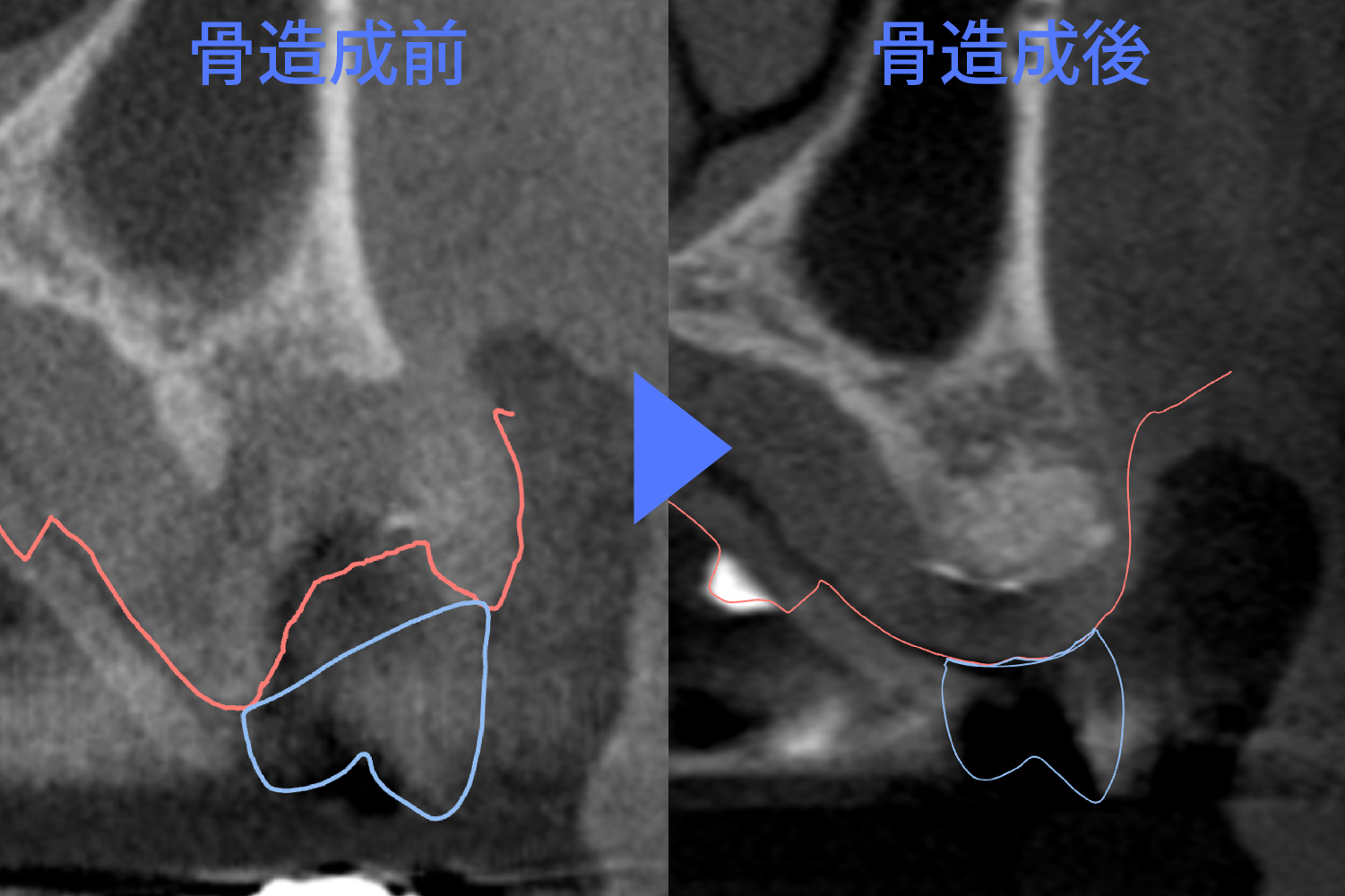 bonegrafting