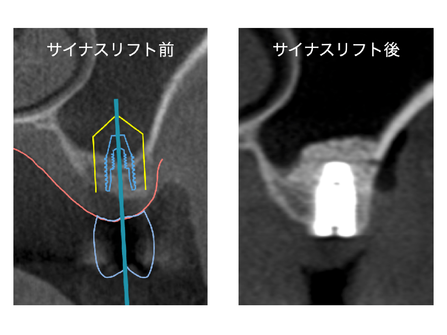 bonegrafting