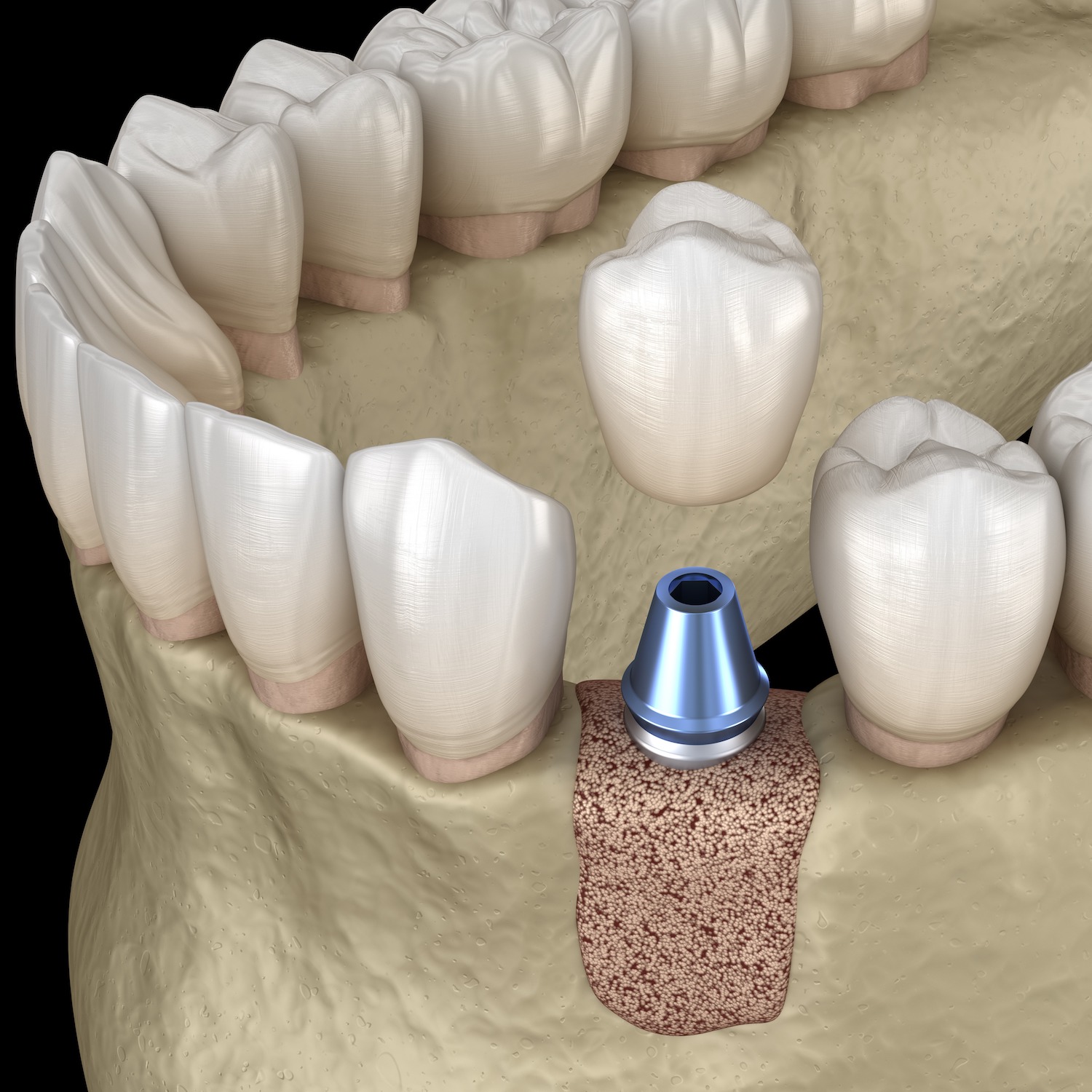 bonegrafting