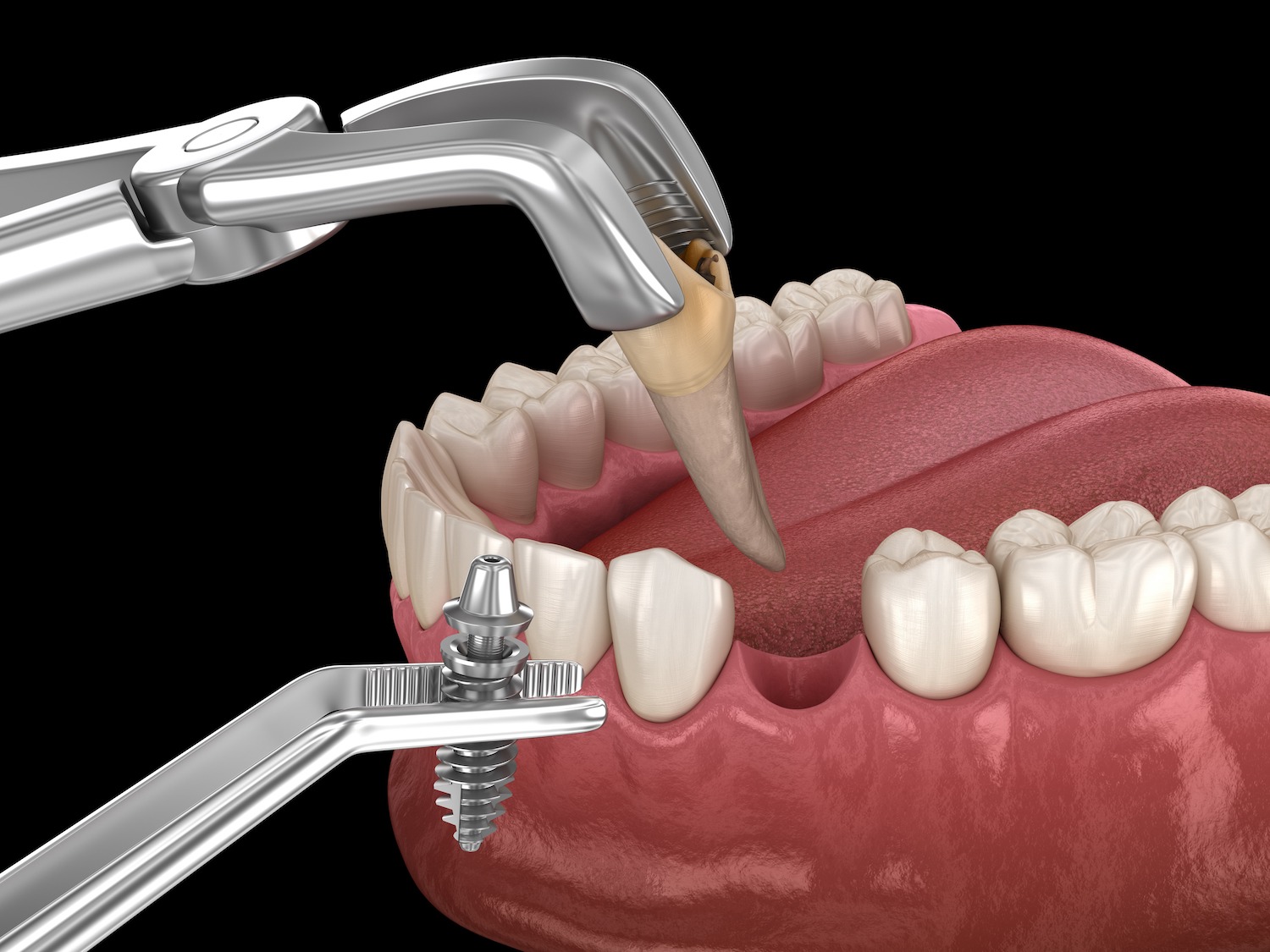 bonegrafting