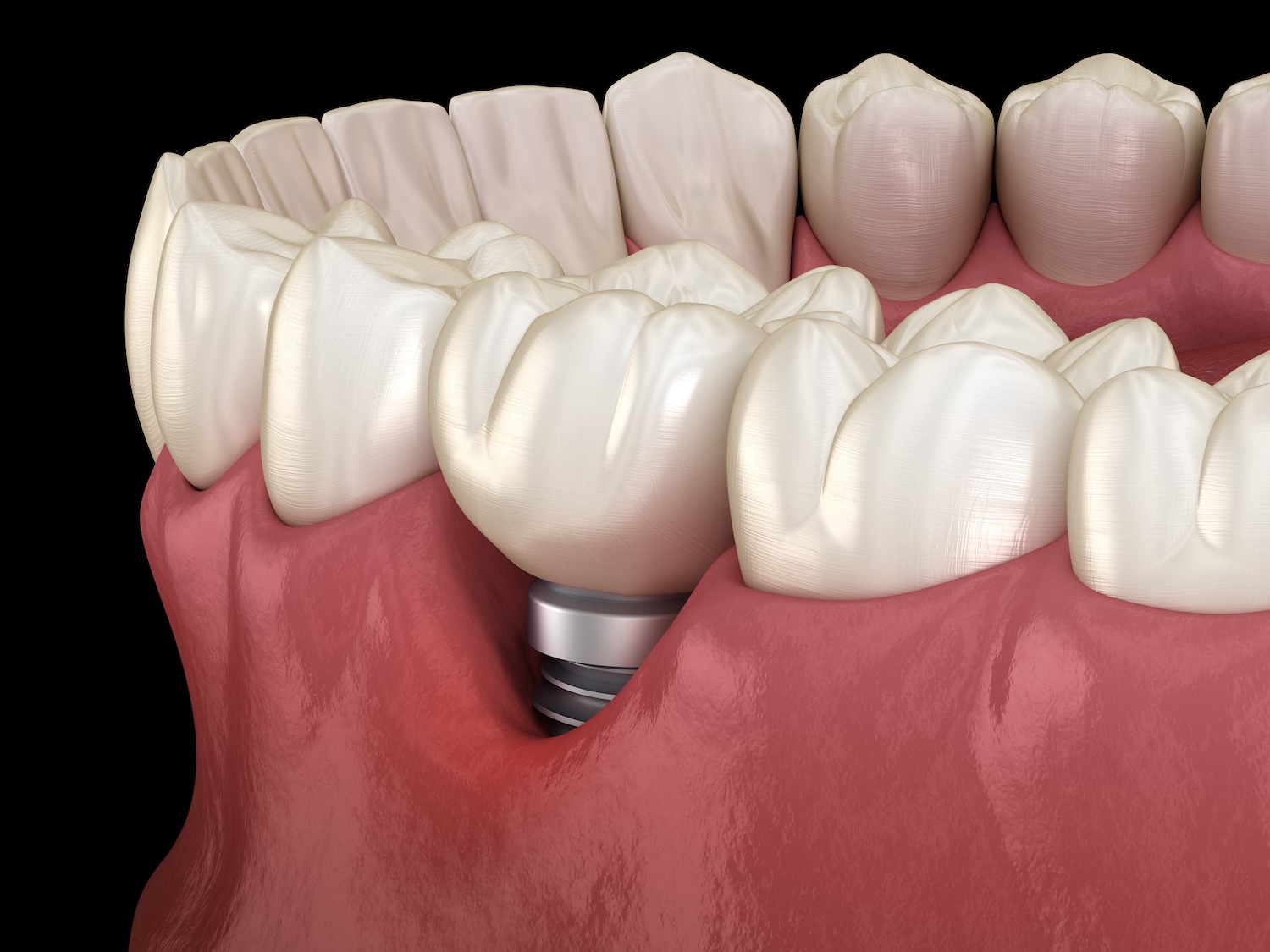 fronttoothimplant