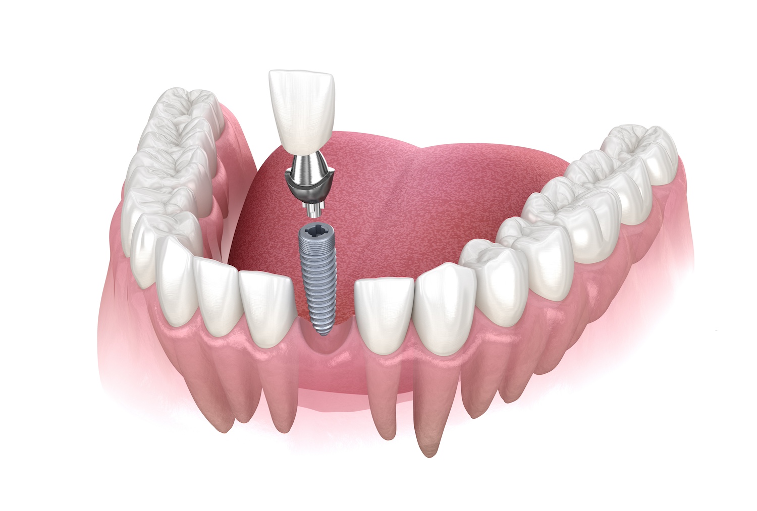 fronttoothimplant