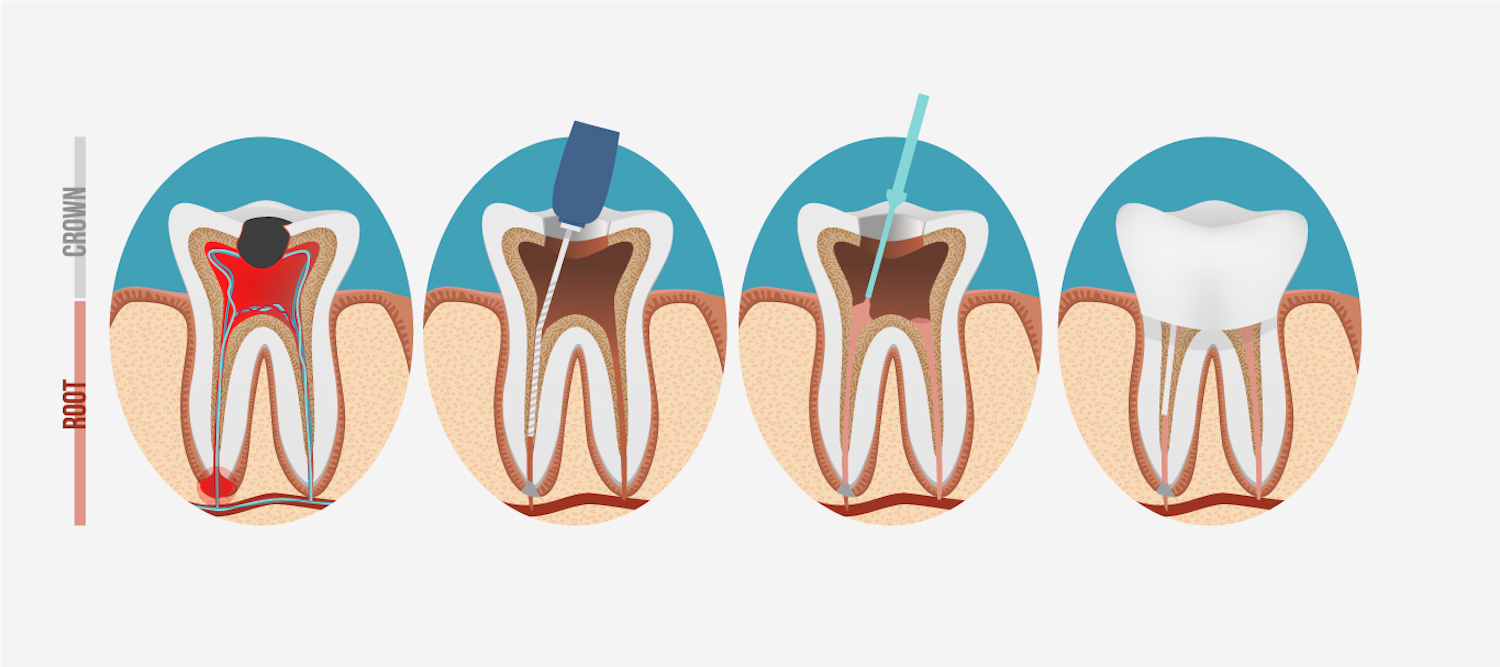 rootcanal