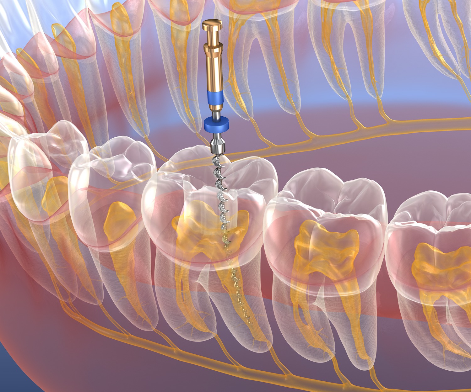 rootcanal