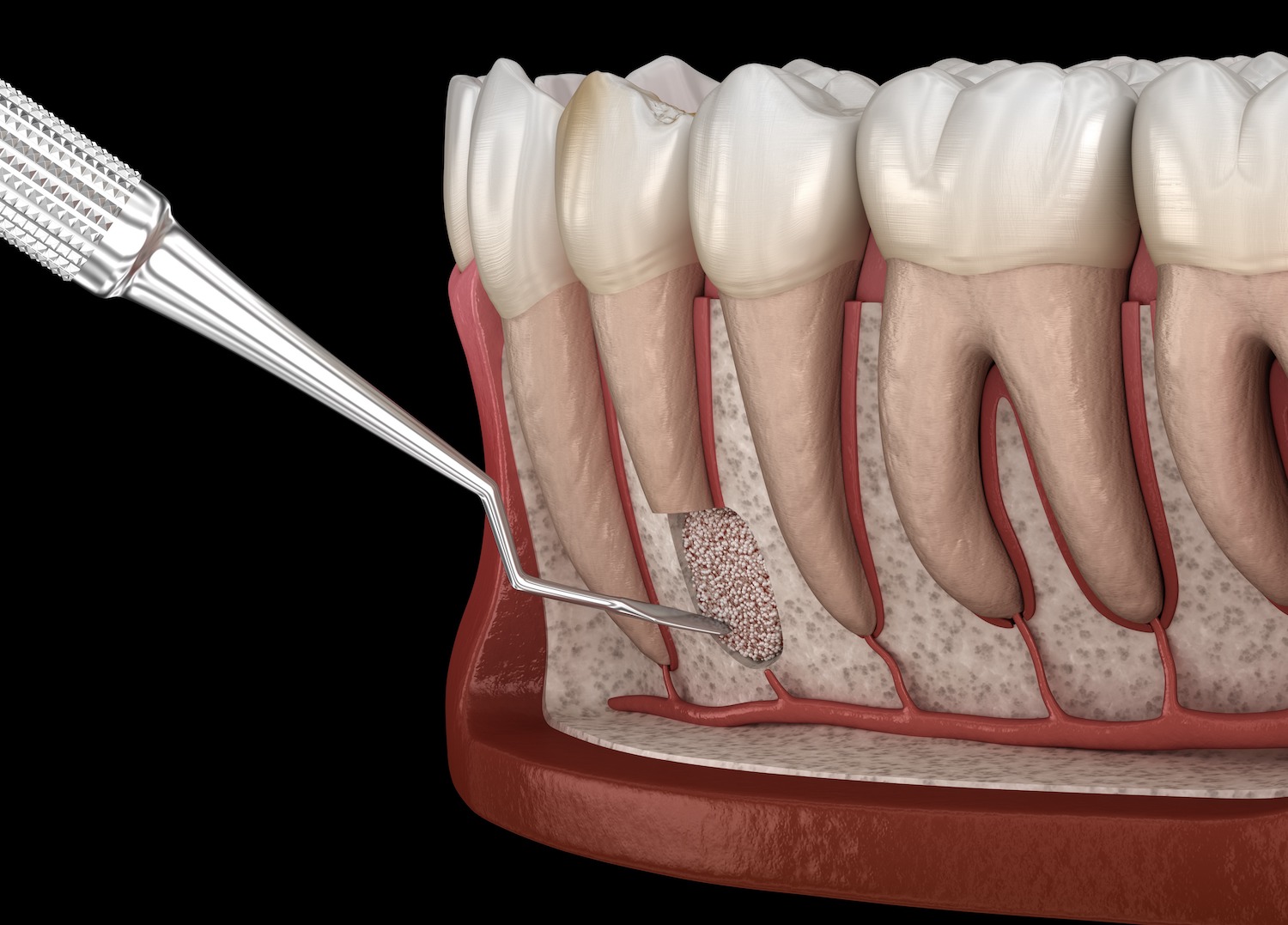 rootcanal